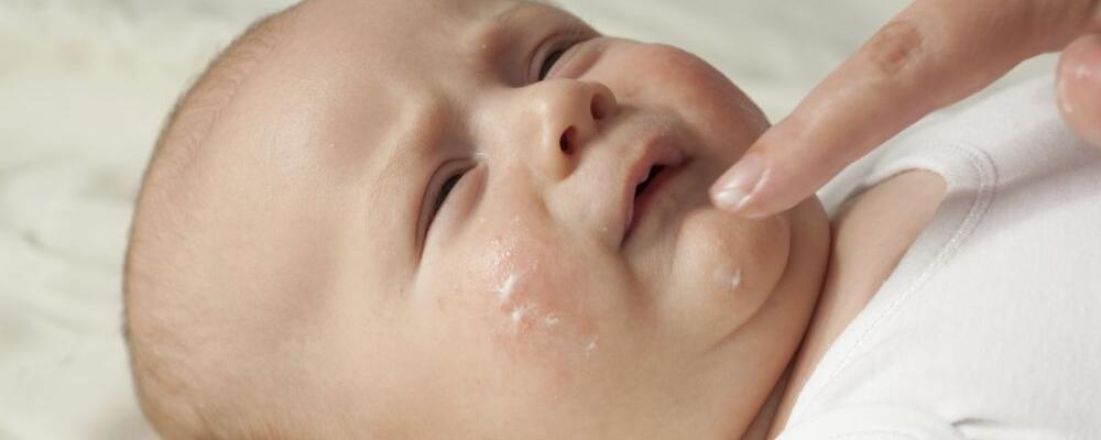 新生儿湿疹怎么办 为什么会长湿疹 婴儿湿疹该如何护理