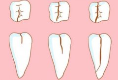 牙齿裂了怎么办？牙齿裂纹如何修复？