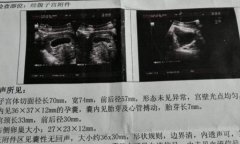 胎囊形状看男女(超准) 生了男孩当时42天