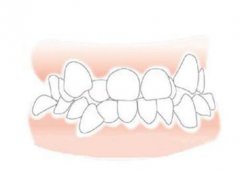 最常见牙齿矫正的后遗症