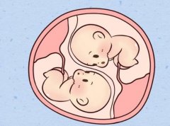 双胞胎会不会同时胎停？双胞胎胎停症状有哪些症状