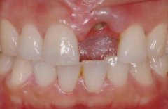 牙种植手术最佳时机是什么时候？