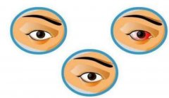 红眼病人 换季红眼病高发期注意预防