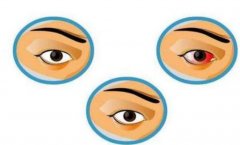 红眼病痒 小心可能是过敏性引起的