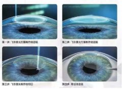 激光近视眼手术对于角膜厚度的要求是多少？