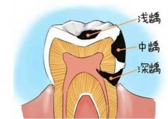 为什么会得牙髓炎 它会自愈吗？