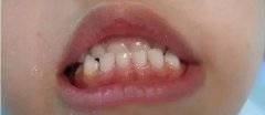 正畸要等孩子换完牙再做吗？什么情况下需要早期矫正？