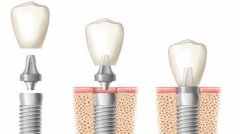 种植牙与传统假牙相比有哪些优越性？