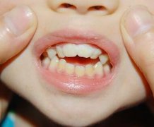 小孩牙齿矫正的年龄是多大？小孩牙齿矫正大概费用是多少？