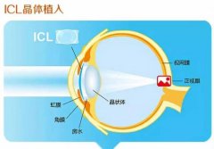 深圳ICL晶体手术需要多少钱?