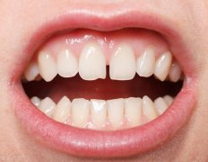 牙齿缝隙大怎么办该如何进行修复？