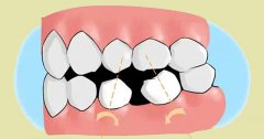 缺牙不管后果有多严重？缺牙如何修复？
