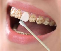 牙缝中扣出来的臭臭的黄泥是什么？
