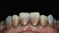 四环素牙是什么牙？能治吗？