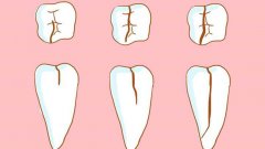 牙隐裂是怎么回事？牙隐裂可以修复吗？