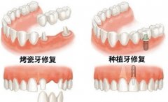 牙齿缺失选择种植牙还是烤瓷牙？烤瓷牙与种植牙的对比！
