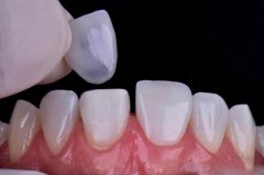 什么样的牙齿适合做牙齿贴面？哪些情况不适合做牙齿贴面？