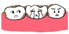 如何清除牙菌斑？牙菌斑过多，是否需要洗牙？
