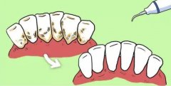 洗牙不伤牙 洗牙的四大误区辨析
