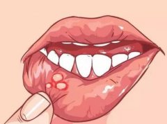 多发性口腔溃疡会遗传？如何形成？