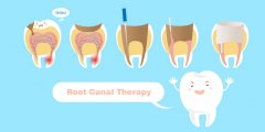 只是牙疼，为什么要做根管治疗？