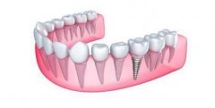 无牙颌种植覆盖义齿修复设计与并发症