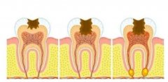 牙髓炎的病因及预防慢性牙髓炎的方法