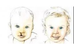 唇腭裂宝宝早期语音训练 家长能做什么？