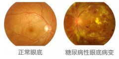 糖尿病视网膜病变可致盲 糖友视力变化需警惕