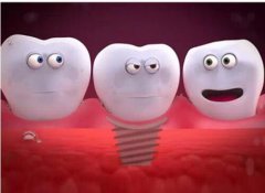 牙齿掉了 你会选择镶牙还是种牙？
