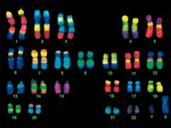 45XO染色体形成的原因及常见的症状介绍