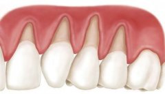 两大“刺激”导致牙龈萎缩？如何预防牙龈萎缩？