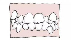 哪些习惯可能会导致牙齿畸形？