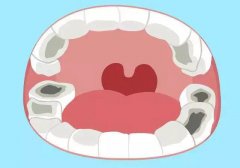 乳牙龋齿需要治疗吗？父母千万不要低估乳牙的重要性！
