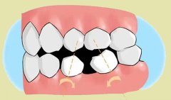 缺牙为何要及时补牙？牙齿缺失八大危害了解一下！