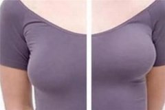 女人为什么容易胸部下垂