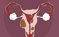 子宫肌瘤8cm做试管婴儿要注意哪些？