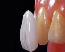 牙齿贴面需要定期复诊吗?