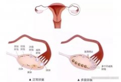 什么是多囊卵巢综合征？多囊卵巢综合征能正常受孕吗？