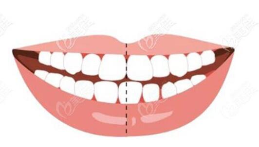 面部矢状中线、牙齿中线等中线口腔正畸时怎么选择？