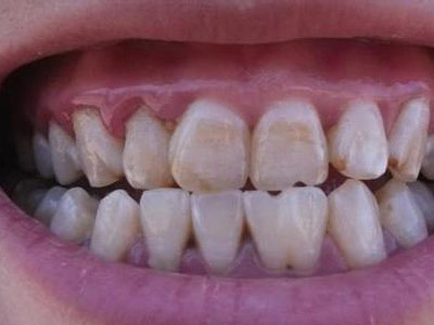 1.正常的牙齿颜色是什么?