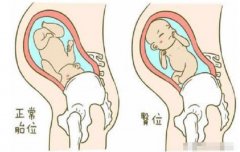 八个月大臀位的胎儿在肚子里面一般是什么姿势？