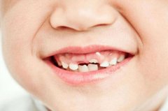儿童乳牙换牙顺序有规律,怎么换、什么时候换家长别迷糊