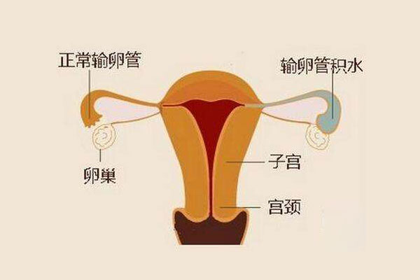 输卵管性不孕是否会影响试管婴儿助孕